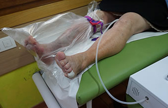 Aplicación local de ozonoterapia