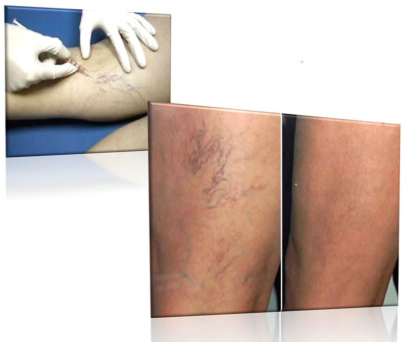 Aplicación local de ozonoterapia